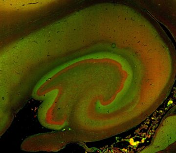 Coupe d’hippocampe de cerveau humain. L’hippocampe est la partie la plus vulnérable dans la MA. La protéine Complexine 1 est marquée en vert. La protéine synaptogyrine 1 est marquée en rouge. Ce sont deux protéines présynaptiques dont l’expression est diminuée dans la MA. Crédit : Tomas Jorda et Gael Barthet