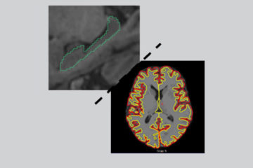 Vincent Planche et al., in Alzheimer’s & Dementia