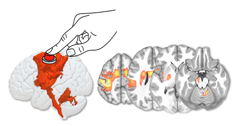 © Michel Thiebaut de Schotten Figure : Activation des réseaux cérébraux associés à une tâche motrice manuelle (main droite). A gauche vue latérale de l’hémisphère cérébral gauche avec ses activations. A droite, coupes horizontales du cerveau montrant ces mêmes activations.