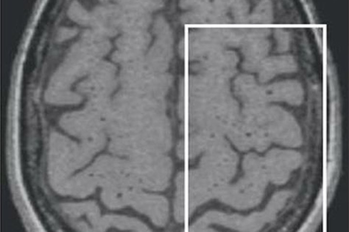 Une vaste étude révèle des mécanismes nouveaux de la maladie des petites artères cérébrales
