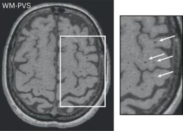 IRM cérébrale montrant une charge importante en espace périvasculaire dans la substance blanche © Nature Medicine