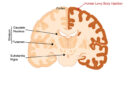 Pilot Study Sheds New Light on Neurodegenerative Diseases