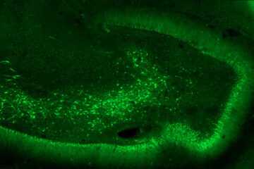 Human hippocampus from epileptic patient infected with a viral vector. Credit : Séverine Deforges