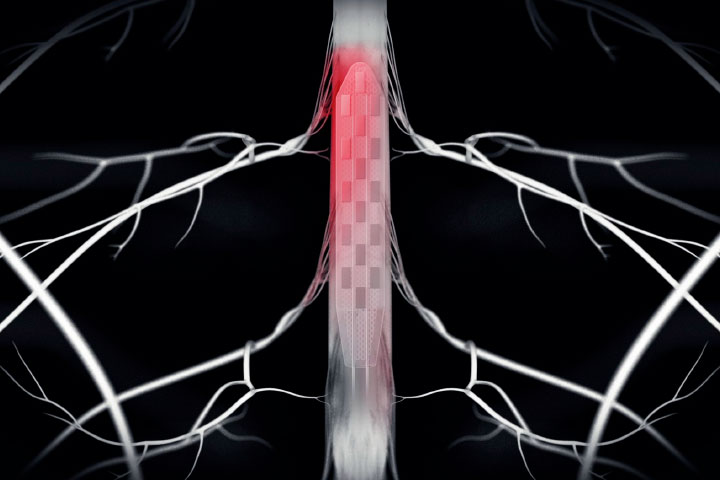 Percée majeure dans le traitement de la maladie de Parkinson : une neuroprothèse permet de restaurer une marche fluide